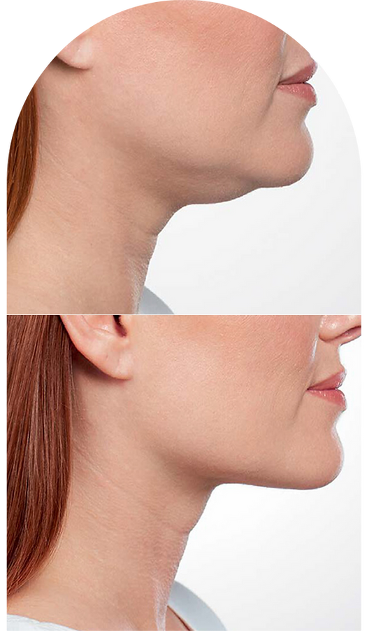 Mesotherapy in Springfield, IL Rose Aesthetics & Wellness Clinic